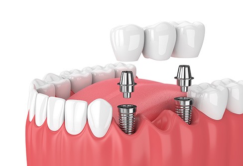 Illustration of implant bridge in lower arch with white background