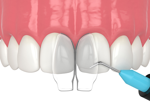 Illustration of dental bonding material being applied to a chipped tooth