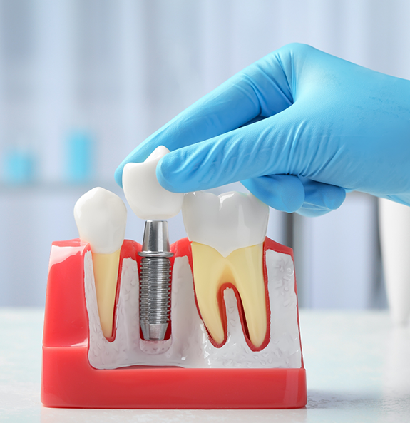 Hand placing a dental crown over a model of a dental implant in Rocky River