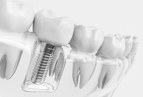 Illustration of a dental implant replacing a missing lower tooth