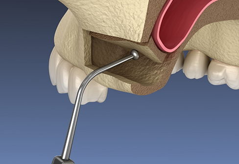 Illustration of a sinus lift