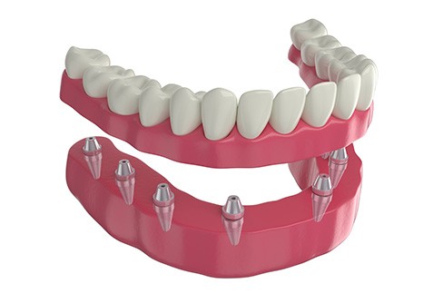 Illustration of implant dentures against white background