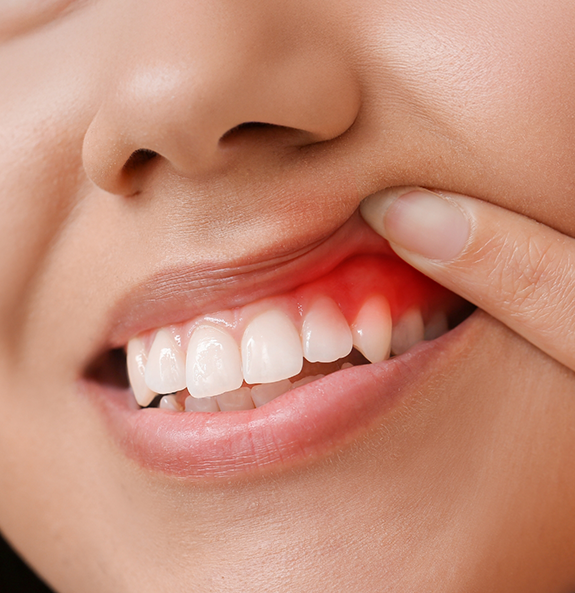 Person pointing to their red gums before gum disease treatment
