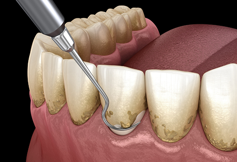 Illustration of a dental scaler clearing plaque buildup from teeth and gums