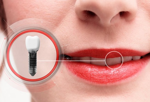 A closeup of a mouth with a dental implant