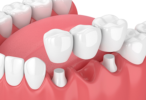 Illustration of a dental bridge replacing a missing tooth