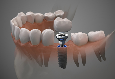 Illustration of a dental implant and crown replacing a missing tooth