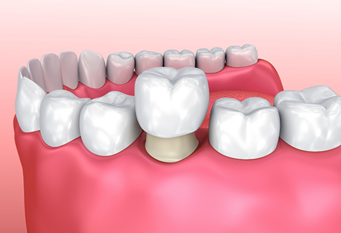 Illustration of a dental crown being fitted over a tooth
