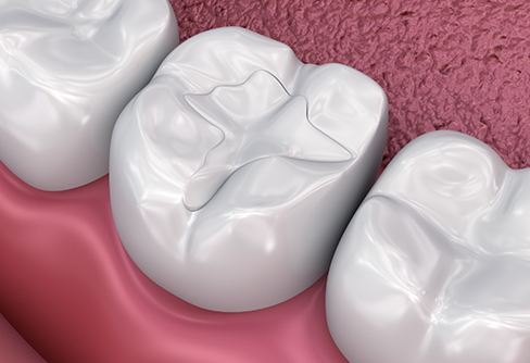 Illustration of a tooth with a white filling