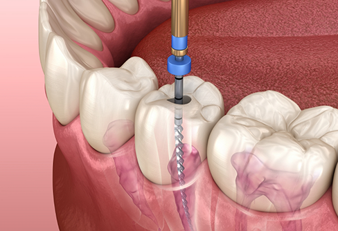 Illustration of a dental instrument treating the inside of a tooth