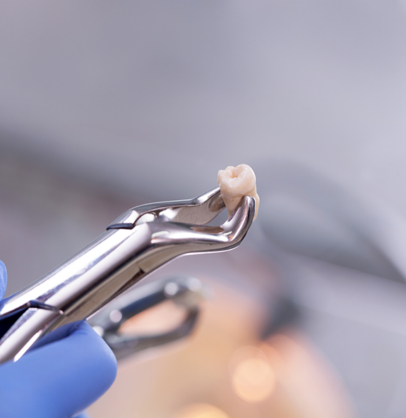 Dental clasp holding an extracted tooth