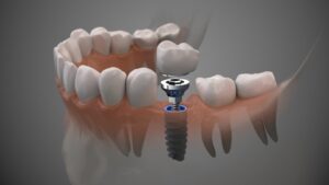 Animated model of dental implants. 